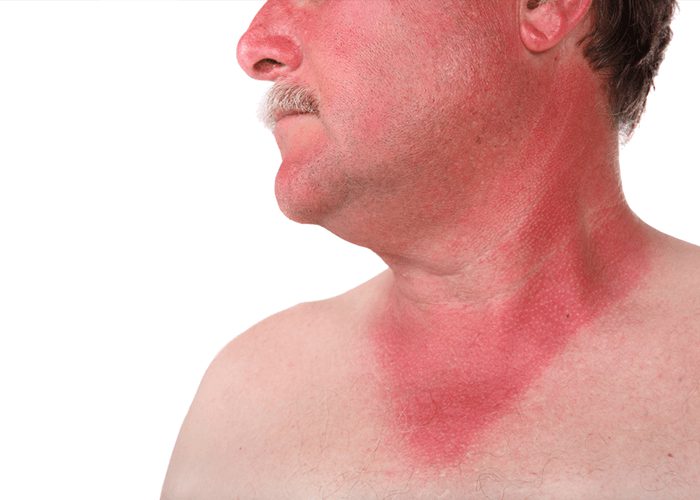 Sunburn Soothers